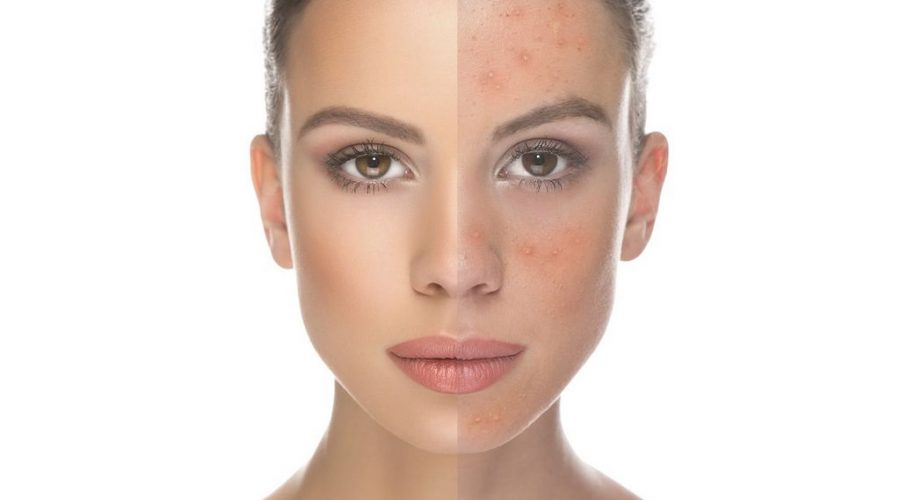 How can I get rid of my rosacea?