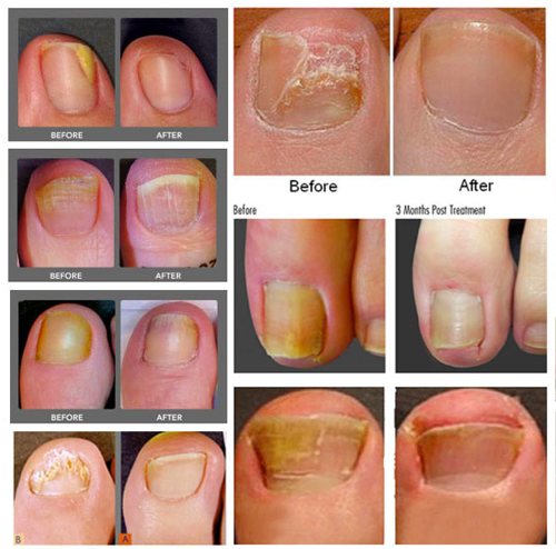 Nail Fungus Removal » Amore Laser